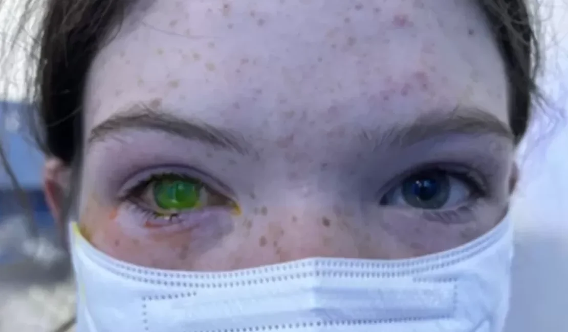 Doença que deixa olho esverdeado e 'dói como parto' alerta australianos