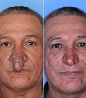 Após 6 anos procurando médicos, pintor com deformidade ganha novo nariz