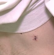 São João de Campina Grande termina com 61 feridos por agulhas, diz hospital