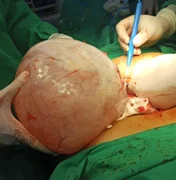 Médicos retiram cisto de 5 kg do ovário de idosa durante cirurgia de emergência
