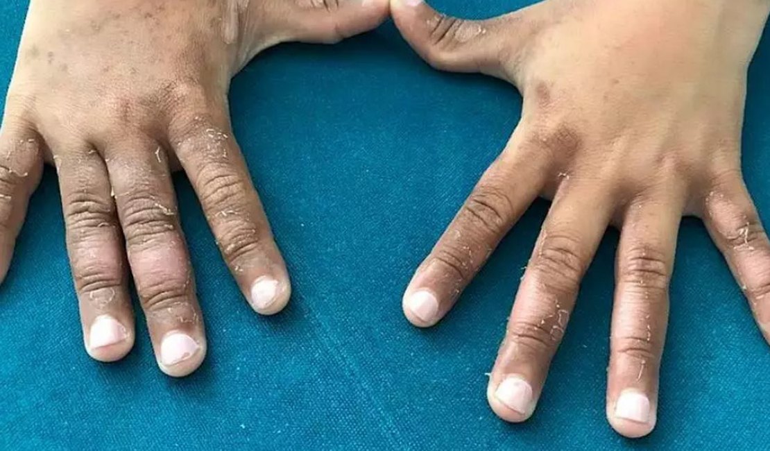 Criança fica com manchas e bolhas ao entrar em mar contaminado
