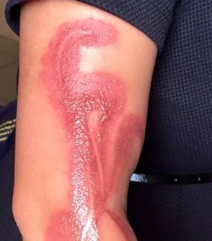Mulher tem braço queimado após dormir sobre iPhone 7