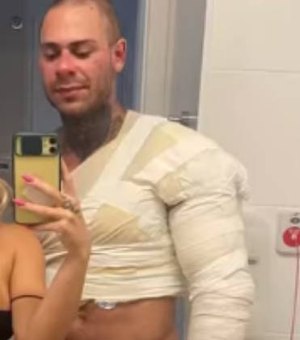 Léo Stronda mostra hematomas cinco meses após acidente com botijão de gás: 'Tudo é fase'