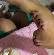 OAB/Arapiraca dá assistência à vítima de assalto que teve dedos decepados
