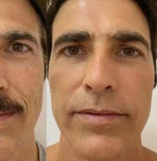 Reynaldo Gianecchini faz rejuvenescimento facial e mostra resultado na web