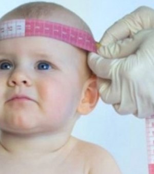 Ministério da Saúde confirma 59 casos de microcefalia em AL