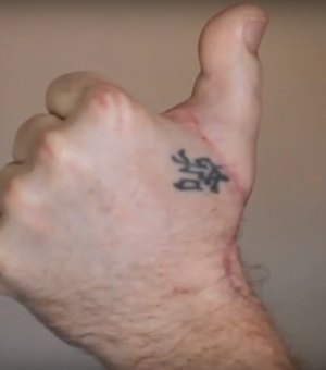 [Vídeo] Após acidente de trabalho, homem tem dedo do pé implantado na mão 