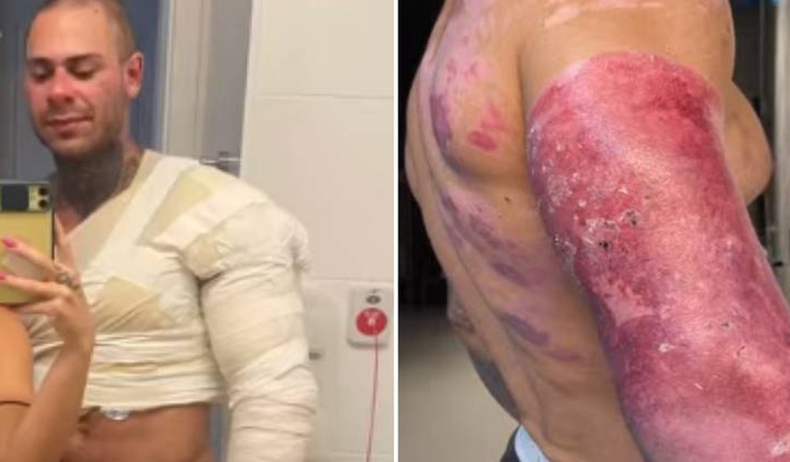 Léo Stronda mostra hematomas cinco meses após acidente com botijão de gás: 'Tudo é fase'