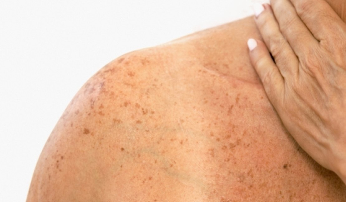 Pinta, mancha ou pequenos ferimentos na pele podem ser indicativos de câncer de pele
