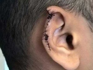 Jovem perde parte da orelha após ser mordido durante briga na zona rural de Pão de Açúcar