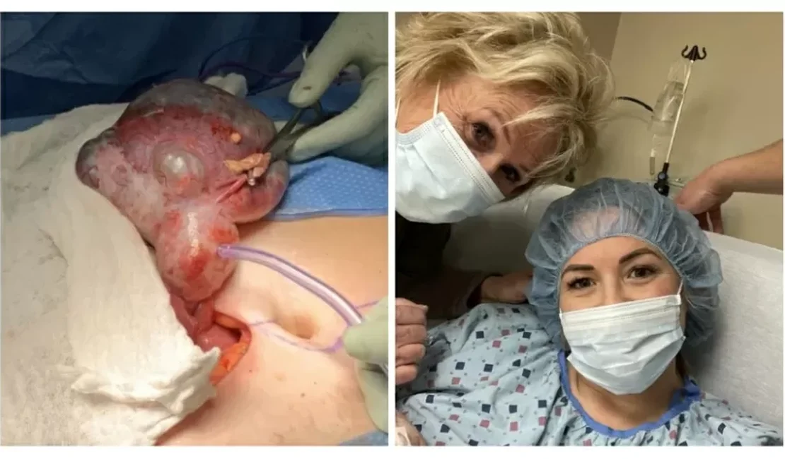 Grávida descobre cisto no ovário que ficou duas vezes maior que o bebê