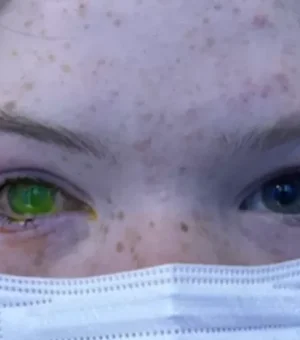 Doença que deixa olho esverdeado e 'dói como parto' alerta australianos