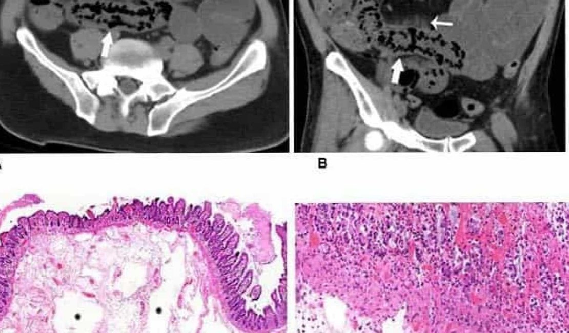 Imagens revelam ferimentos no intestino causadas pelo novo coronavírus