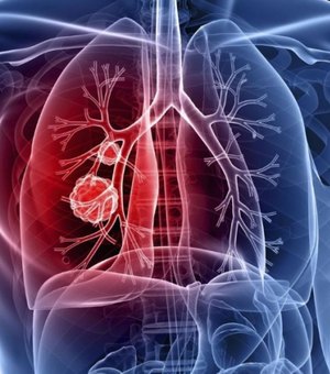 Incidência de câncer de pulmão  no mundo aumenta entre as mulheres