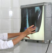 Cai o número de casos e mortes por tuberculose no Estado