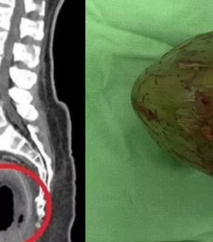 Cirurgiões removem coco verde de 9 cm do ânus de homem em Taiwan