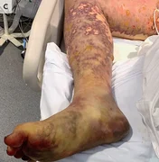 Jovem tem pernas amputadas após infecção por comida estragada