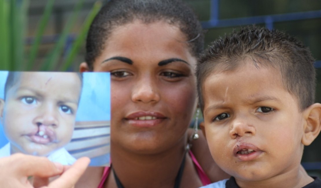 Alagoanos iniciam nova vida após cirurgias de Lábio Leporino
