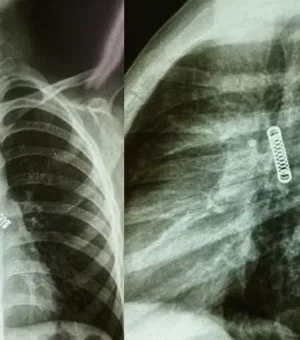 Menino sofre de tosse constante e médicos acham mola de metal no pulmão