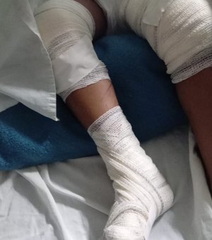 Porto Calvo: Criança é atropelada por adolescente que empinou moto em via pública