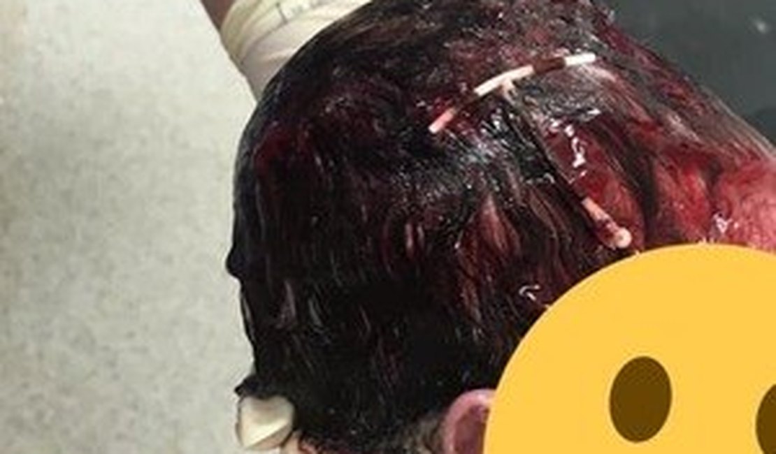 Bebê nasce com DIU preso no cabelo. Médico explica o caso