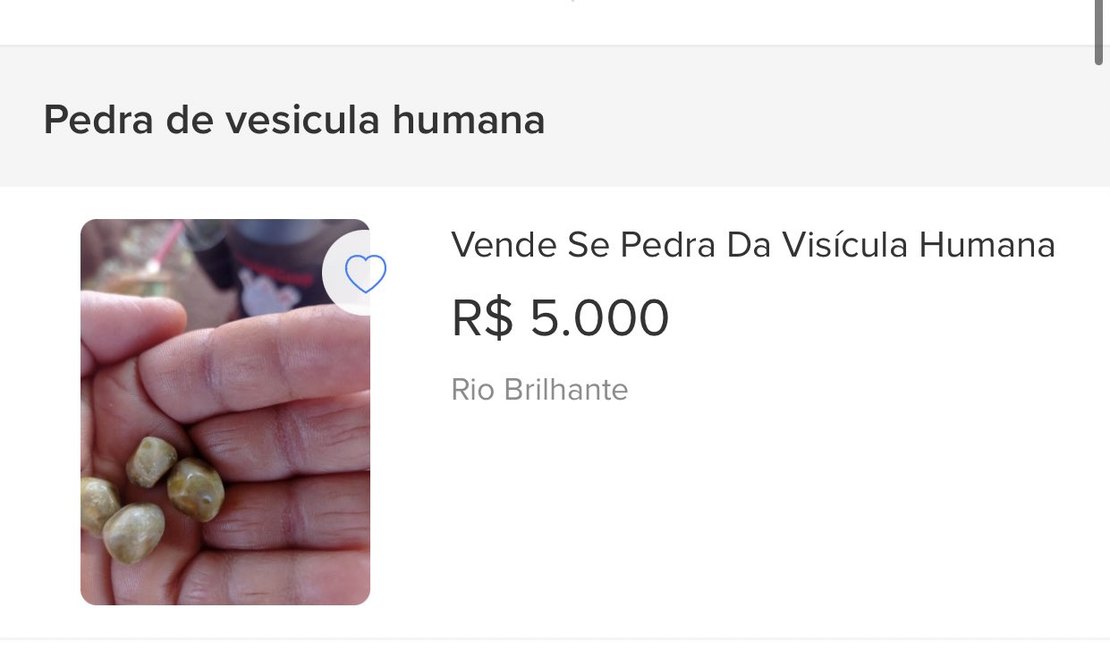 Brasileiros utilizam plataformas de venda online para comercializar pedras de vesícula