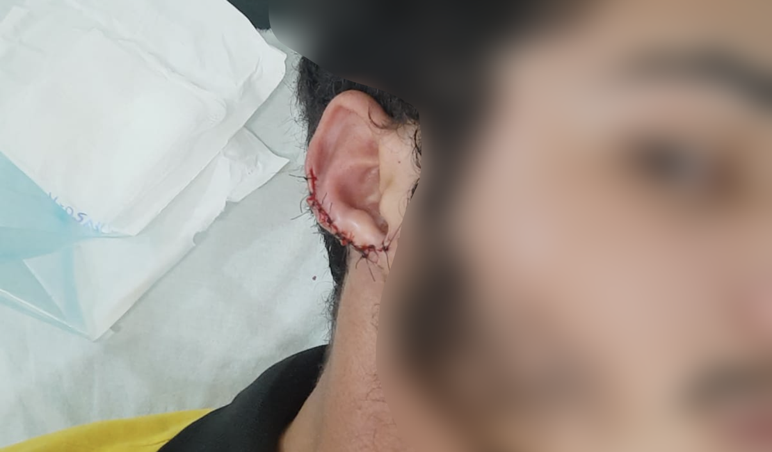 [Vídeo] Garçom tem pedaço de orelha arrancado ao levar mordida de cliente em São José da Tapera