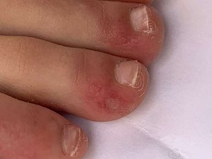 O que são os 'dedos de covid', um dos mais novos possíveis sintomas identificados da doença?
