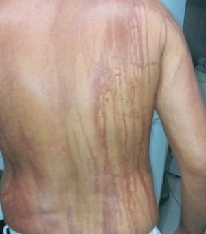 Turista que teve manchas no corpo após banho de mar na Bahia é internado 