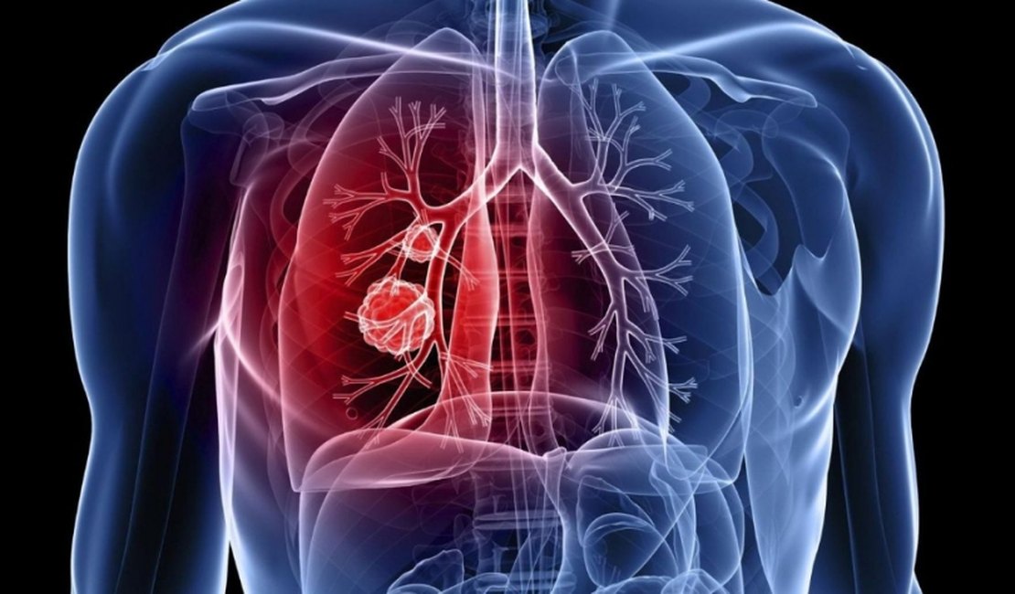 ANVISA aprova Alectinibe para o tratamento de câncer de pulmão