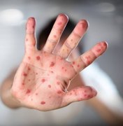 Prefeitura dá detalhes sobre vacinação contra sarampo e poliomielite em Arapiraca