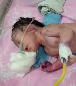 Índia registra nascimento de 'bebê-sereia', que atrai multidão a maternidade