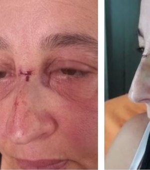 Após ataque com bexiga d’água, mulher leva pontos e pega infecção ocular