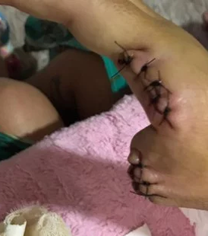 OAB/Arapiraca dá assistência à vítima de assalto que teve dedos decepados