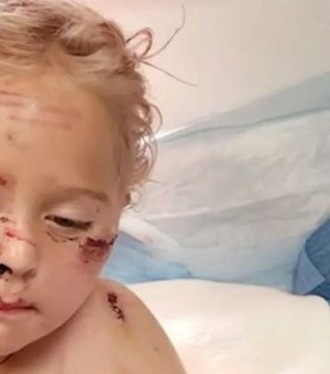 Menina de 5 anos leva 50 pontos no rosto após ataque de cachorro