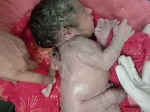 Bebê nasce com 3ª mão nas costas na Índia; fenômeno é raro