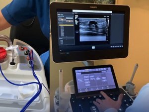 Biópsia a vácuo por ultrassonografia amplia opções de exames mamários em Alagoas