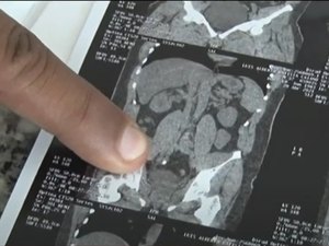 Paciente renal pede ajuda para realizar cirurgia urgente em Maceió