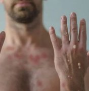 Alagoas registra 14 casos suspeitos de varíola dos macacos