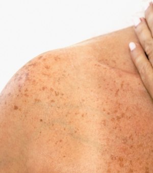 Câncer de pele: protetor solar não bloqueia totalmente raios UV