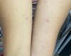 Surto de coceira em Recife foi provocado por mariposas