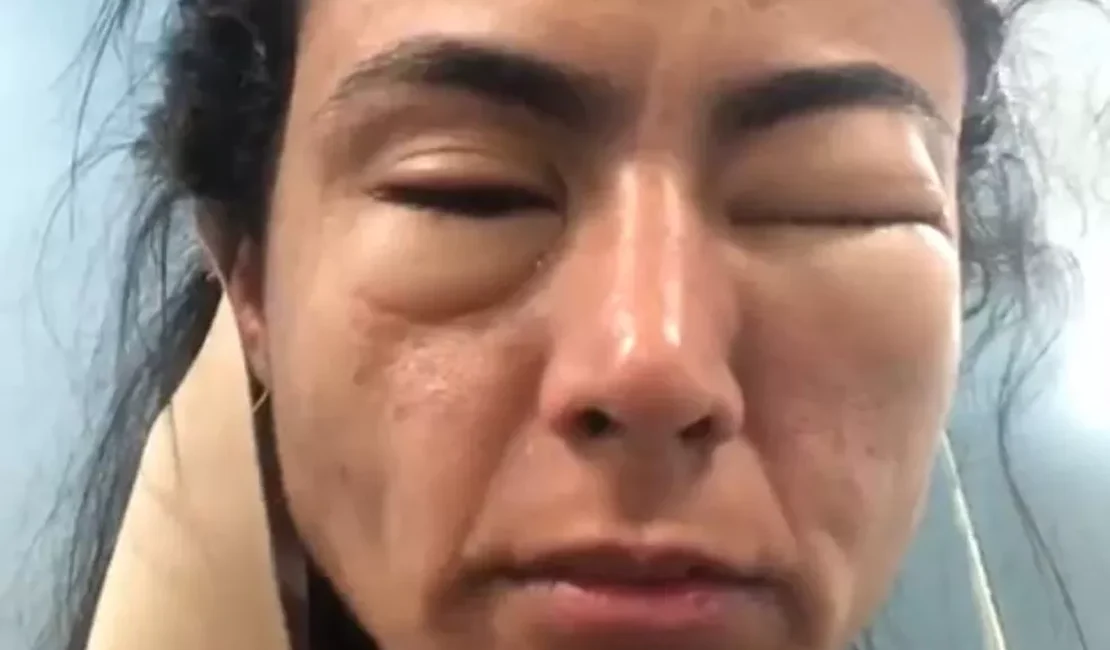 Estudante viraliza ao fazer post sobre episódio em que ficou com rosto deformado após comer camarões