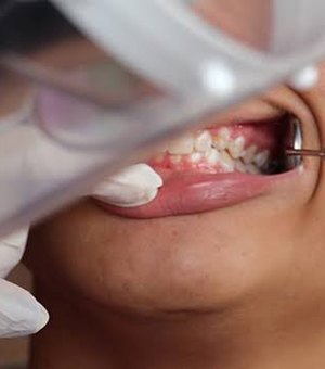Pesquisa sobre saúde bucal será realizada em Arapiraca