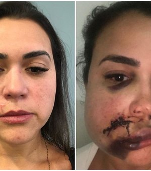 Milka Borges recebe laudo de cicatriz um ano após agressão: “Irreversível”