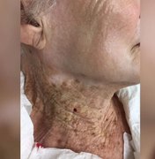 Estudo analisa pele de idosa que, por 40 anos, usou filtro solar só no rosto
