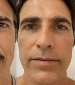 Reynaldo Gianecchini faz rejuvenescimento facial e mostra resultado na web