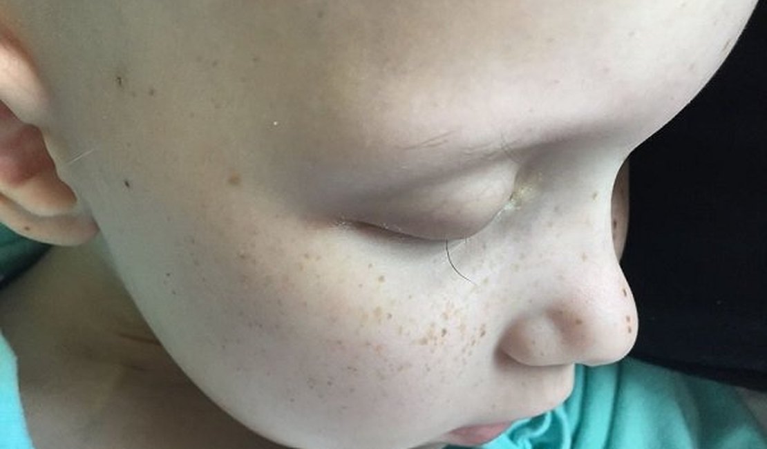 Pai fotografa último fio dos cílios de filha que enfrenta câncer