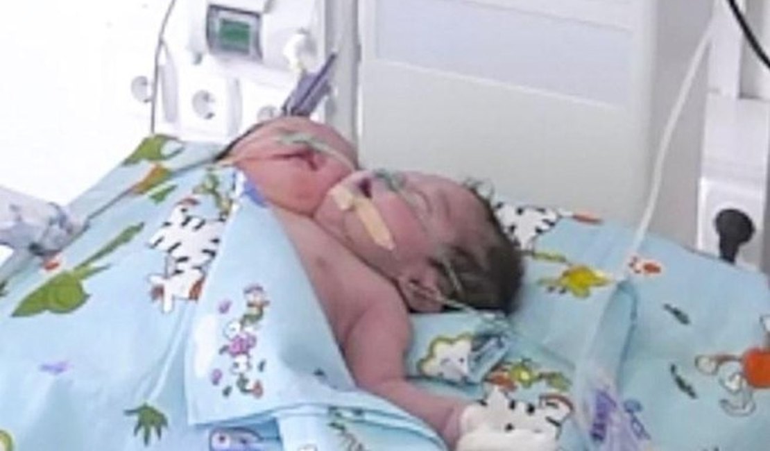 Mãe tem bebê de duas cabeças e é forçada a entregá-lo para adoção