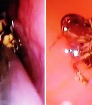 Médicos descobrem barata viva em crânio de mulher que se queixava de dores na cabeça
