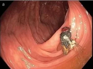 Médicos encontram mosca viva dentro de intestino de paciente durante exame